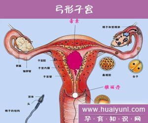 弓形子宫是由于孕期缺乏一种物质,导致发育异常变异会导致难怀孕,易