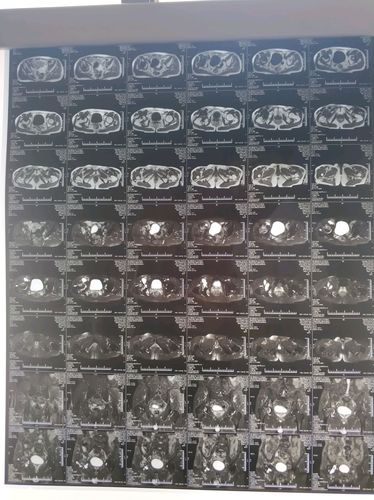 术前髋关节核磁共振:右髋关节骨质改变,考虑缺血性坏死