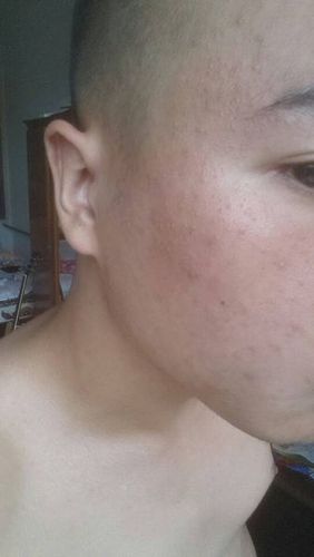 很小很小,一大片头皮上也有,两侧鬓角也有很多.白天呈