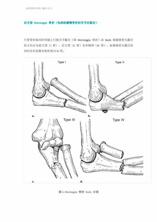 尺骨冠突骨折分型.pdf 10页