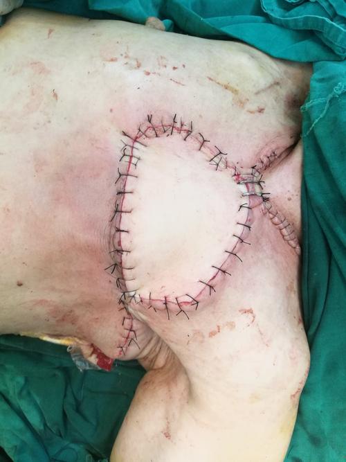 局部晚期乳腺癌创面修复