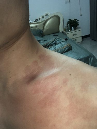 脖子左侧下部有淤血?