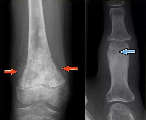 骨肿瘤--鉴别诊断的分析路径|软骨瘤|骨肉瘤|纤维瘤