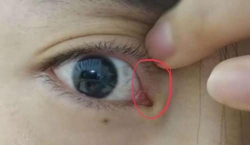 内眼角长睫毛了怎么办.现在一闭眼特别扎