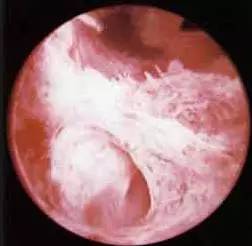 你必须了解什么叫宫腔粘连 为什么我说没有做过人流术的人生才是完美