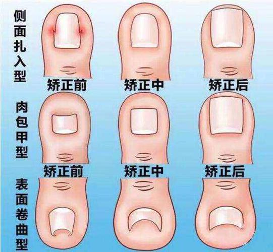 改变指甲生长物理弯曲度,改变指甲生长方向,让指甲不再往肉里长.
