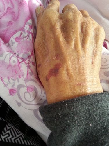 老人手上张红色斑 一块一块的 还有点像淤血 有图片 怎么回事