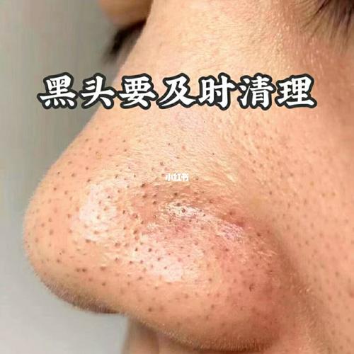 照镜子自检一下 看看自己的鼻子 白头,黑头,粉刺 ,大毛孔 你们有么_去