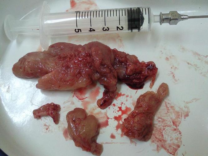 鼻息肉图片 (41)