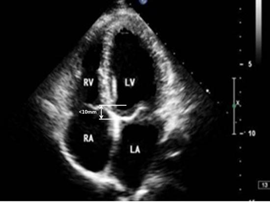 心尖四腔心切面(上)