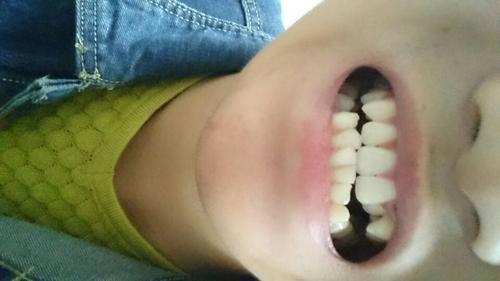 如果去当兵 牙齿是不是不合格呀