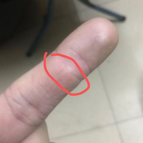 【图】前段时间搬东西,手指节这里长了个硬硬的,好像在骨里面长的,不