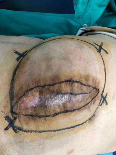 开腹结合腹腔镜行右下腹壁切口疝修补术