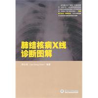 肺结核病x线诊断图解