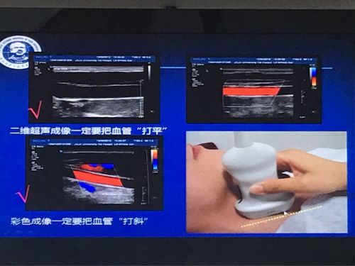 颈动脉超声检查规范-刑英琦