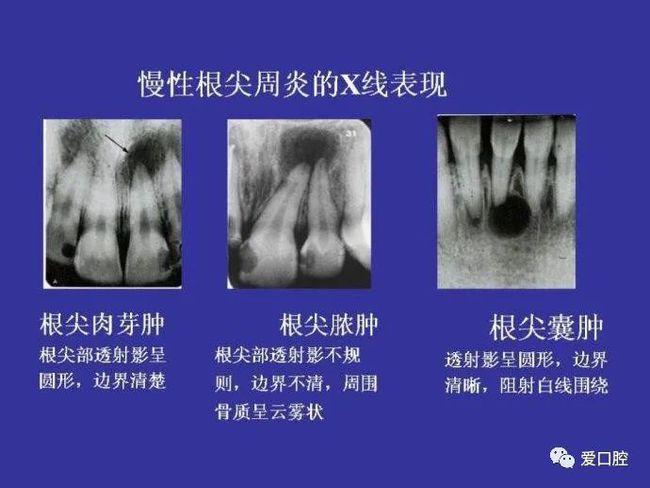 慢性根尖周炎病变的4个类型