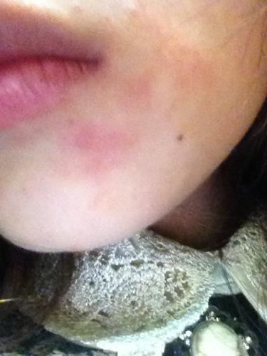 脸上经常会长象癣一样红红的东西,偶尔有点痒,上次去医院医生配了地