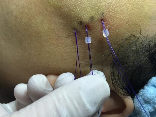 韩国最新的面部埋线提升不同于传统拉皮术,利用特殊的倒钩型手术缝线