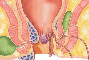 做痔疮手术一般需要多少钱啊