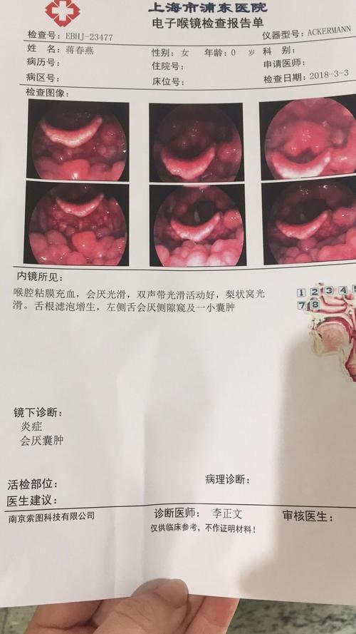会厌囊肿护理措施