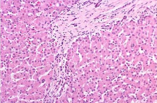 胆汁性肝硬化的鉴别诊断