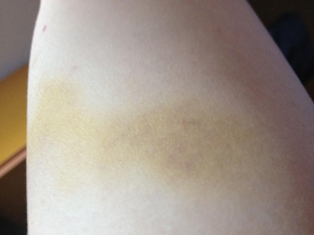 手臂上长了个黄斑,也不知道什么时候出现的,仔细看有红点在黄斑下面