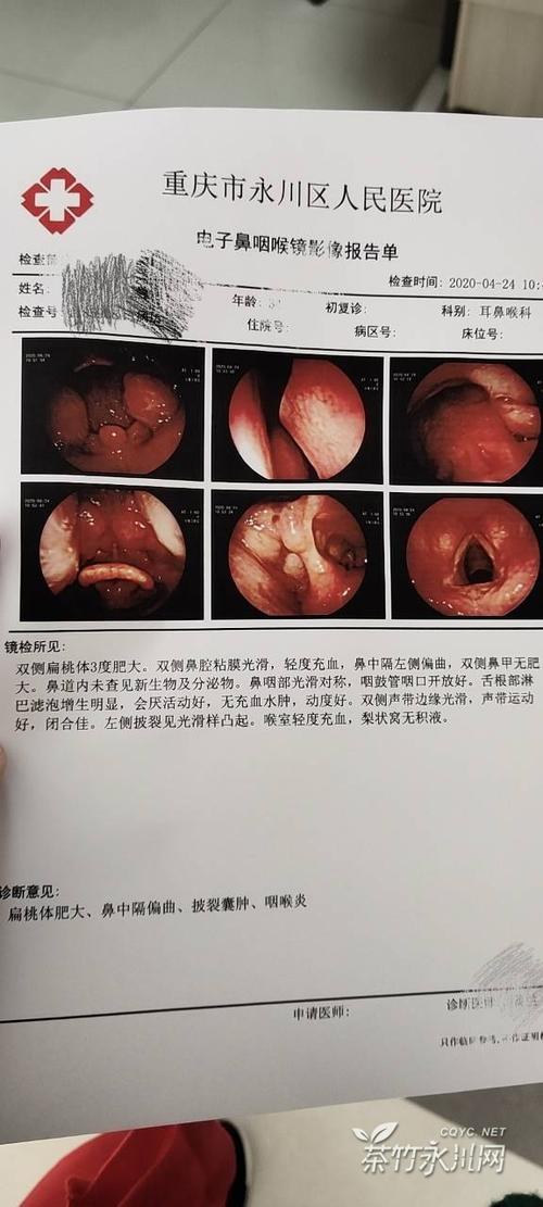 有懂医的吗?披裂囊肿咽喉炎必须手术吗?