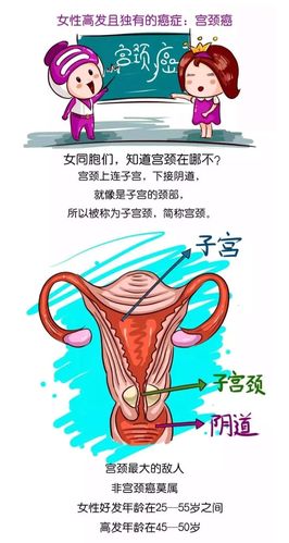 为什么要做宫颈癌筛查