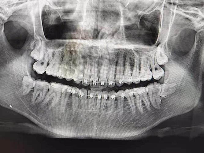 在学校痛了两周 一回家就去拍牙片啦然后说左下是阻生智齿 等消炎后