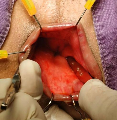 手术笔记|经肛门直肠异物取出术