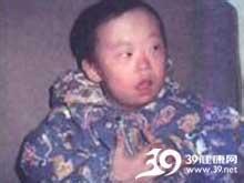        又称先天愚型,21三体综合征,是由于常