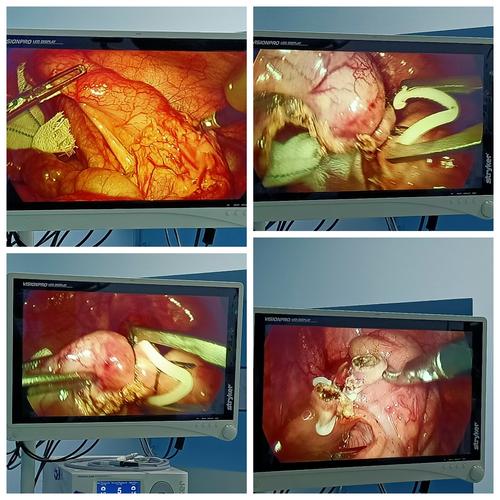 手术麻醉科,普外科同努力!小儿阑尾炎腔镜"了断"真给力!