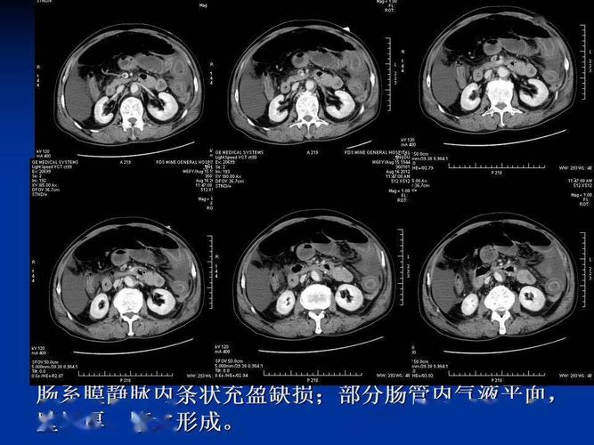 详细肠梗阻的分类及影像学表现高清图片文字讲解