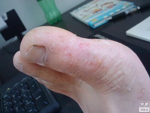 脚癣有什么表现