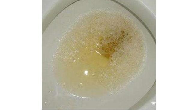 尿液泡沫越多,肾脏损伤就越严重吗?做好4点或能改善尿蛋白!