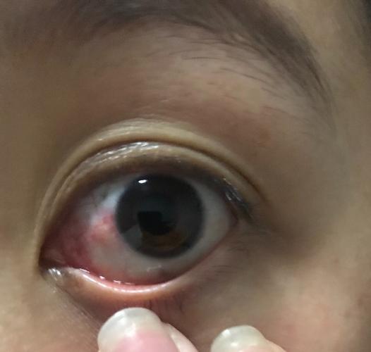 眼白长了个疙瘩,是什么怎么办
