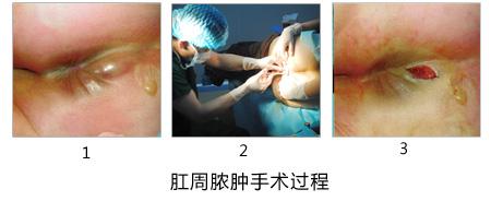 男性肛周脓肿是怎样形成的