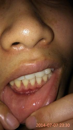 都能看到牙根了,很痛,牙根下面还烂了一点