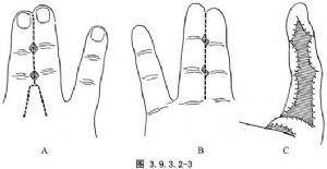 9.3.2-1,3.9.3.2-2).此两法指蹼成形两指根部均需行植