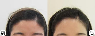发际线脱毛的效果