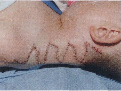 典型病例1:连续z成形术矫正先天性蹼颈畸形