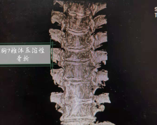 经详细了解老人病史及体格检查,在我院做胸椎ct平扫 三维重建及mri示