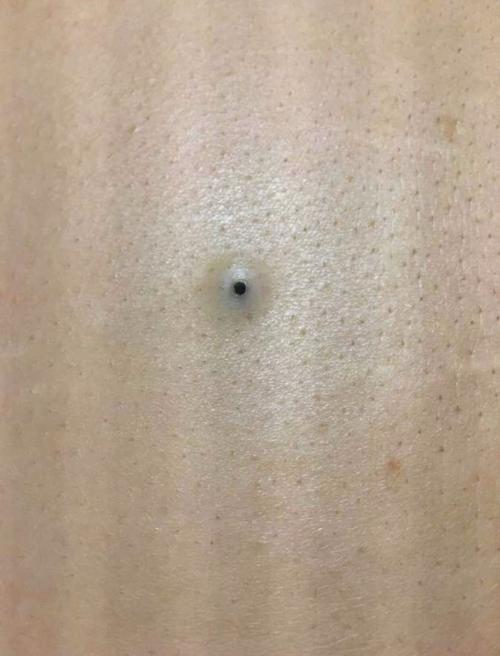 后背的这种疙瘩不是火疙瘩,是粉刺样痣