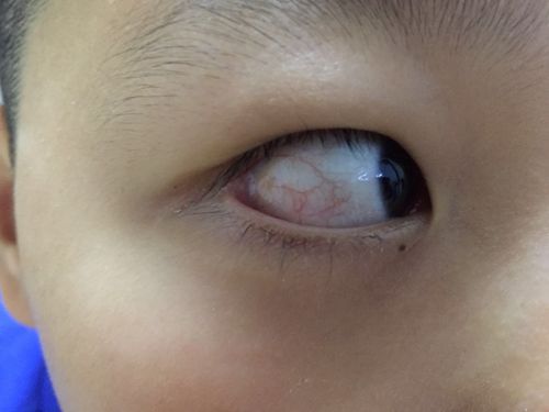 对的,眼睑闭合不全会造成角膜炎,治疗上查找病因,看是什么原因引起