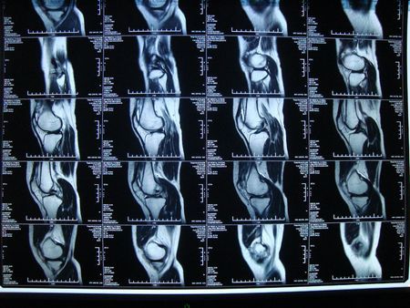 这是我母亲膝盖的核磁共振片子, 求医生帮忙鉴定一下伤势.