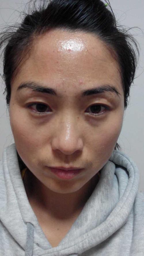 生完孩子美妈们 有长斑的经历吗?