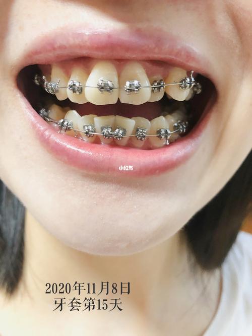 牙套_口腔_洗牙_正畸_补牙_美妆