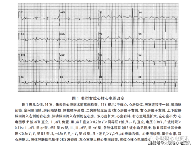 右位心样心电图改变及意义