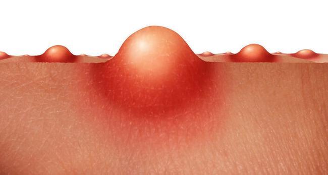 反而还长成丘疹,摸上去坚硬,或者长成软软的肉条,那可能是hpv病毒感染