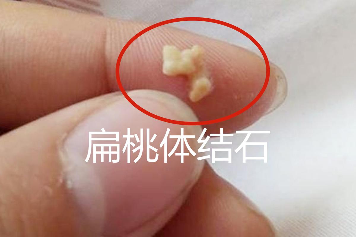 如何改善扁桃体结石的情况?